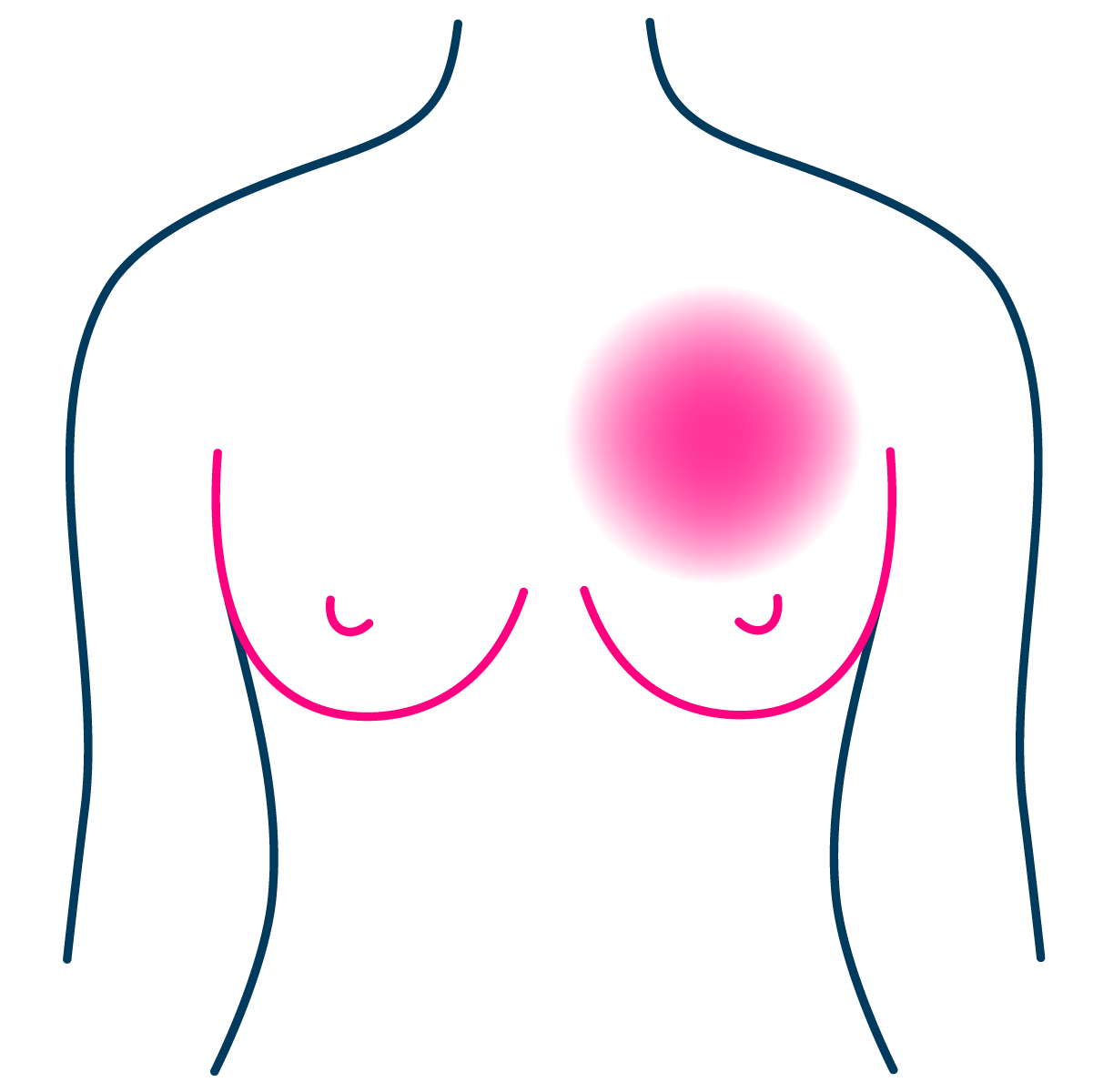 Pain radiating from a breast