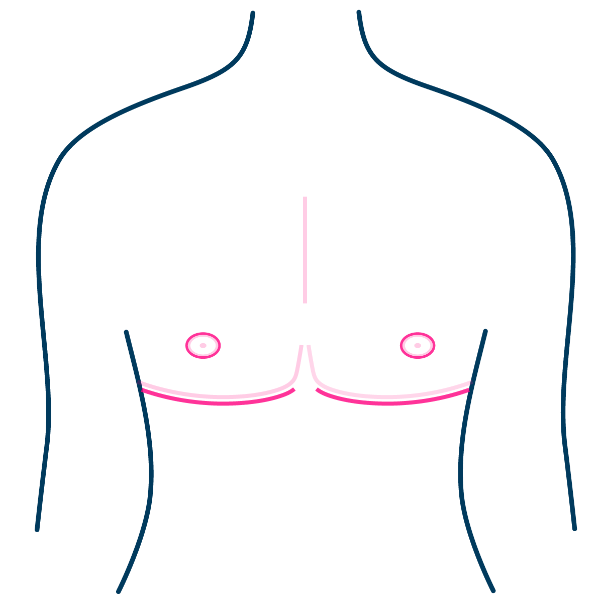 Buttonhole Top Surgery