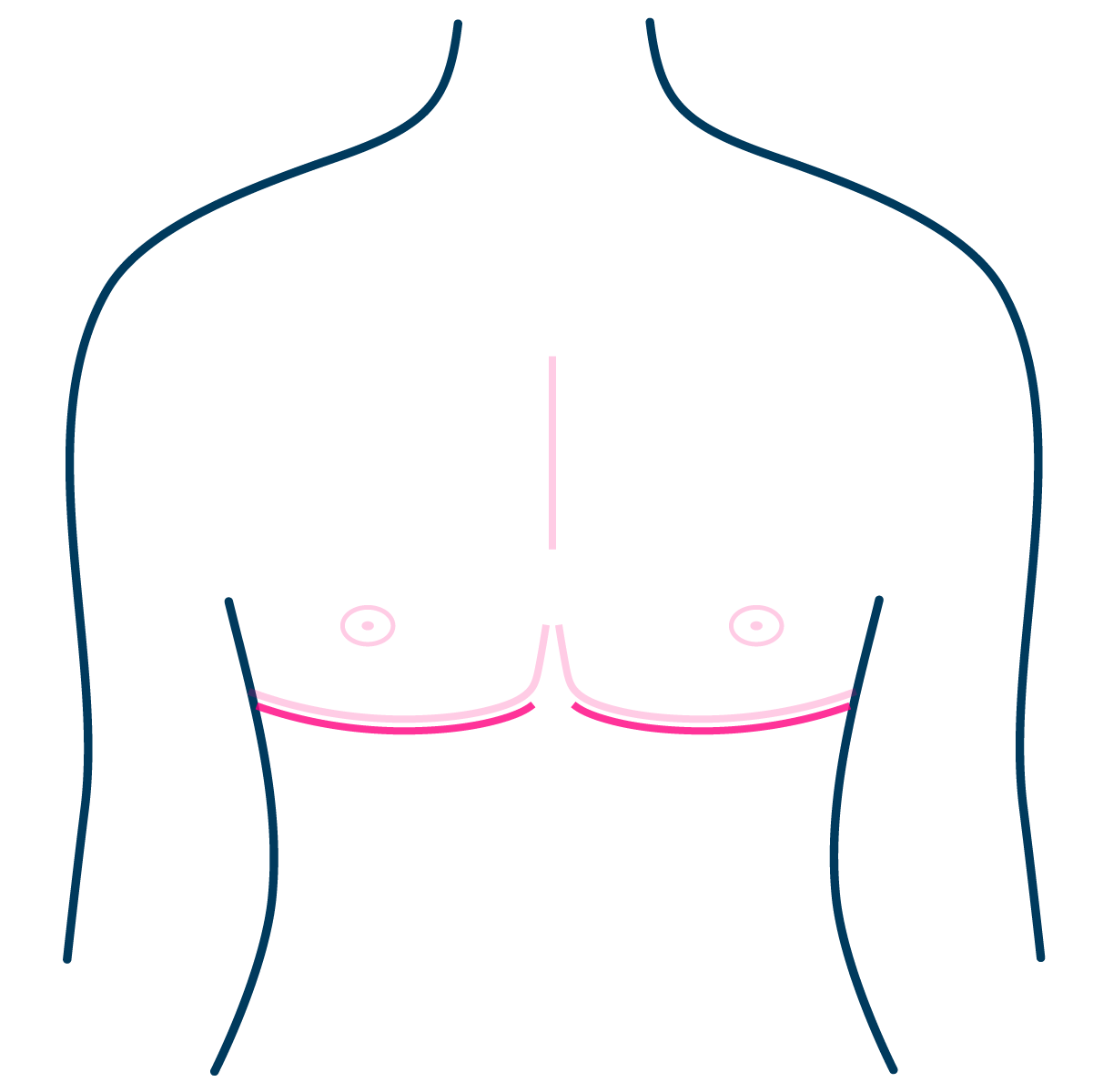 Double Incision Mastectomy