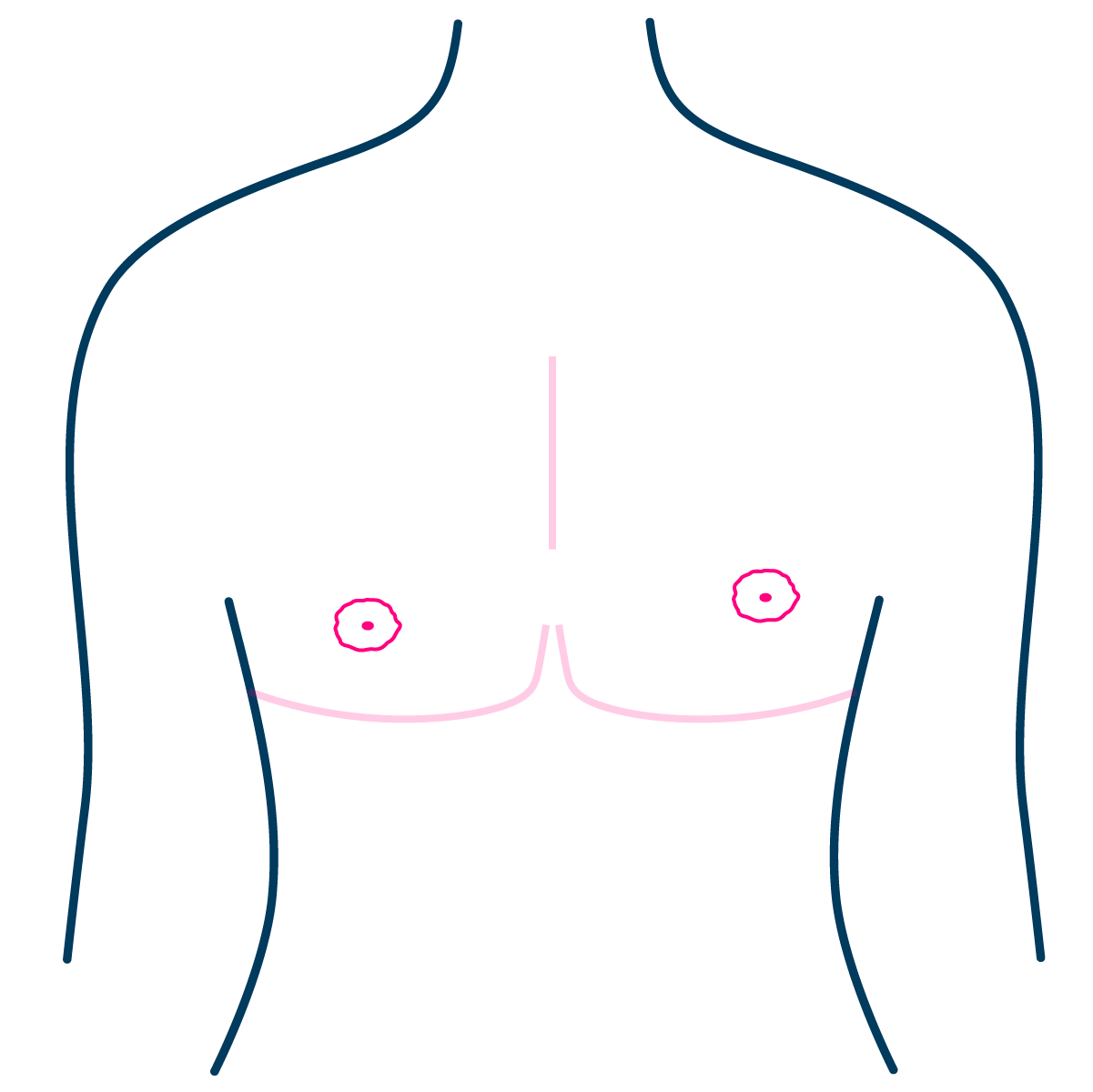 Free Nipple Graft - Complication - Displacement