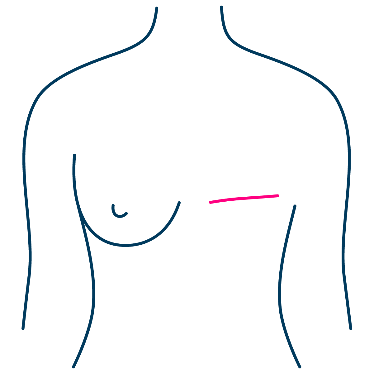 Mastectomy 01