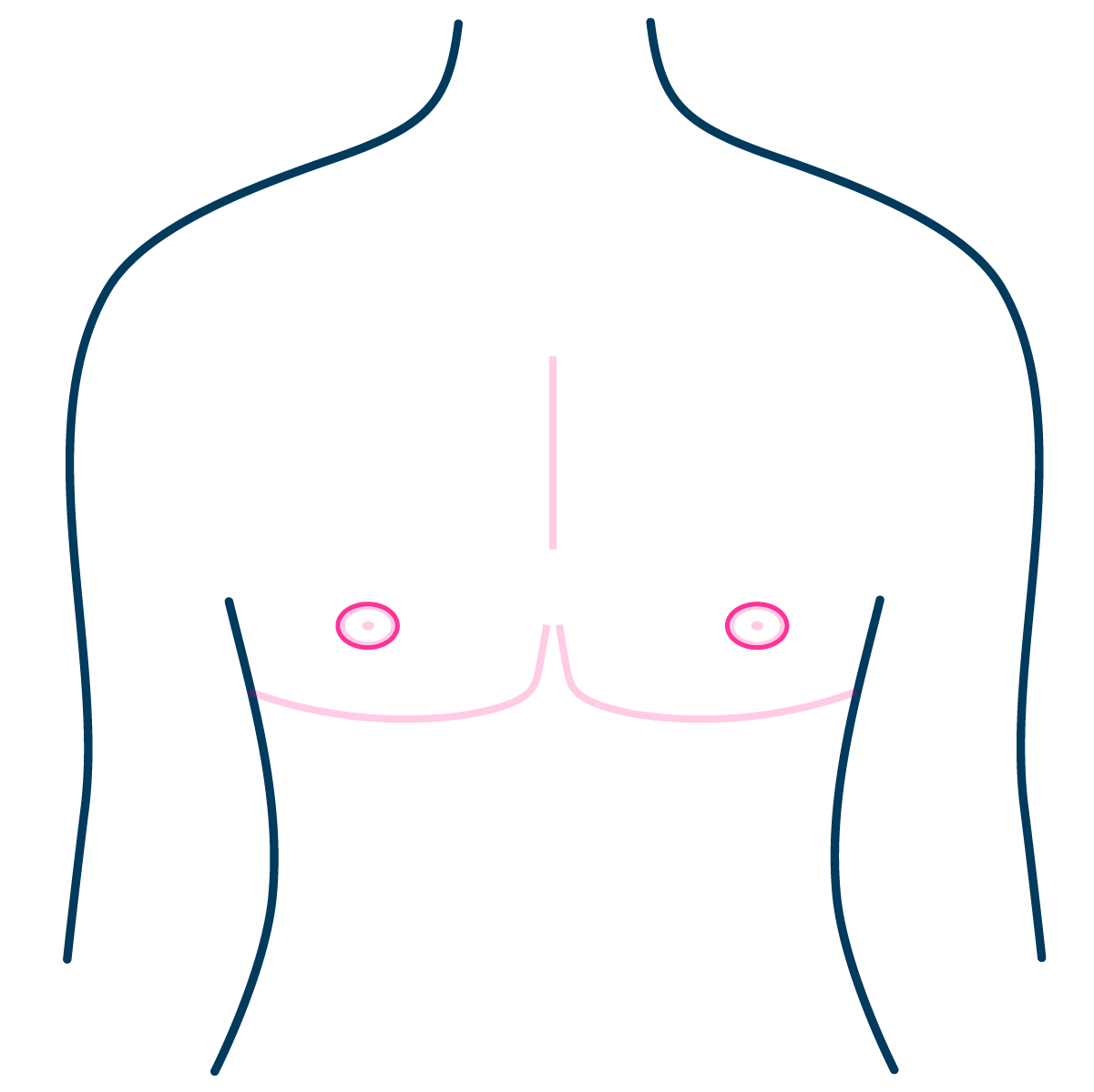 Double Incision Mastectomy